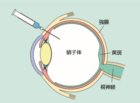 硝子体注射