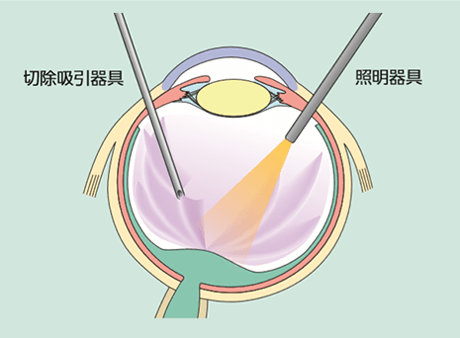 硝子体手術