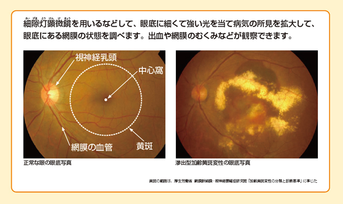 細隙灯顕微鏡を用いるなどして、眼底に細くて強い光を当て、病気の所見を拡大して眼底にある網膜の状態を調べます。出血や網膜のむくみなどが観察できます