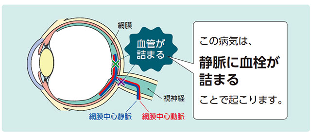 網膜静脈閉塞症の原因