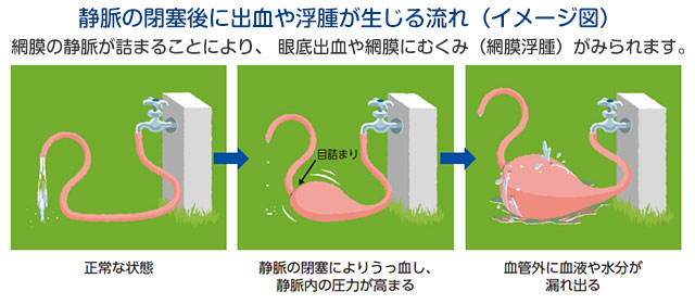 静脈の閉塞後に出血や浮腫が生じる流れ(イメージ図)網膜の静脈が詰まることにより、 眼底出血や網膜にむくみ(網膜浮腫)がみられます。