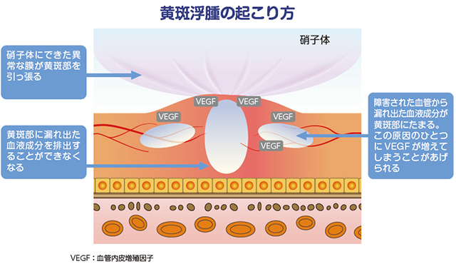 黄斑浮腫の起こり方