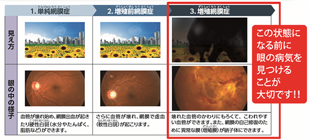 糖尿病黄斑浮腫の症状